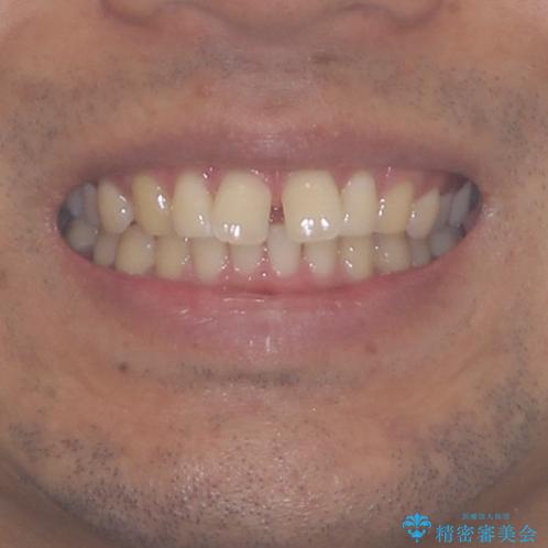 上顎の出っ歯とすきっ歯 補助装置を用いたインビザライン矯正の治療前(顔貌)