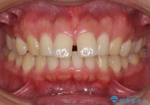 上顎の出っ歯とすきっ歯　補助装置を用いたインビザライン矯正の症例 治療前