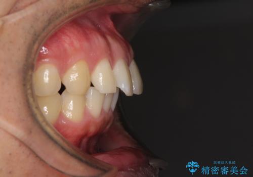 上顎の出っ歯とすきっ歯 補助装置を用いたインビザライン矯正の治療前
