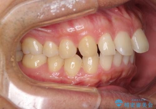 上顎の出っ歯とすきっ歯 補助装置を用いたインビザライン矯正の治療前