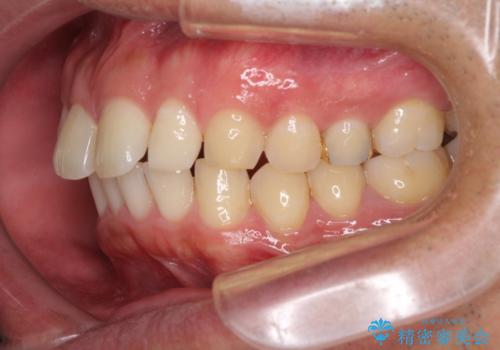 上顎の出っ歯とすきっ歯　補助装置を用いたインビザライン矯正の治療前