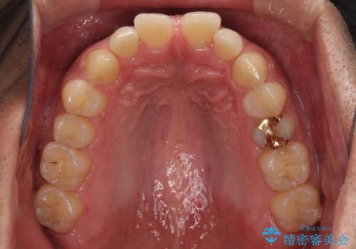 上顎の出っ歯とすきっ歯　補助装置を用いたインビザライン矯正の治療前