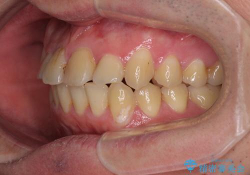歯列全体のクロスバイトを治したい　ワイヤー装置による矯正治療の治療後