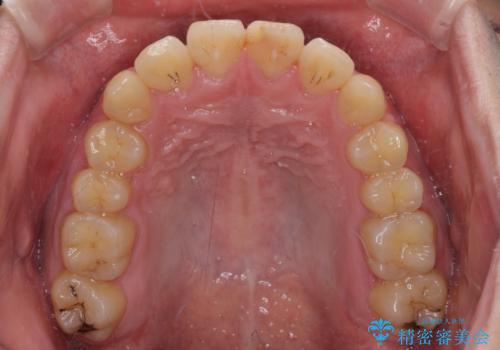 歯列全体のクロスバイトを治したい　ワイヤー装置による矯正治療の治療後