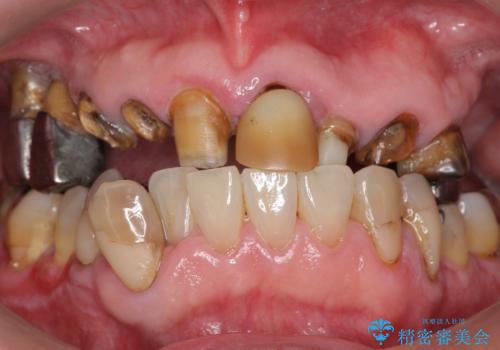 被せ物がとれたまま放置していた セラミックで綺麗に 50代男性の治療前