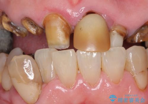 被せ物がとれたまま放置していた セラミックで綺麗に 50代男性の治療前