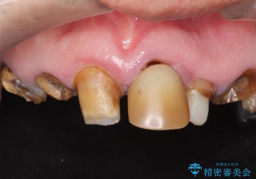 被せ物がとれたまま放置していた セラミックで綺麗に 50代男性の症例 治療前