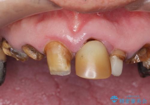 被せ物がとれたまま放置していた セラミックで綺麗に 50代男性の治療前