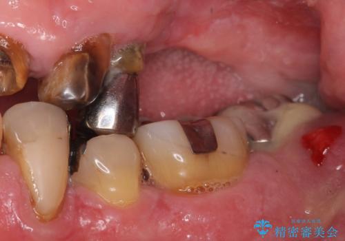 他院でインプラントできないと言われた 上顎洞底挙上術を併用したインプラント 50代男性の治療前