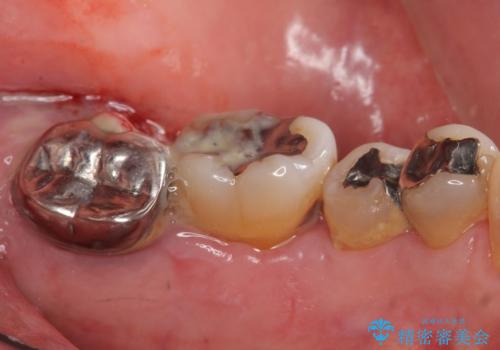 歯周病を治す 再生療法 50代男性の症例 治療前