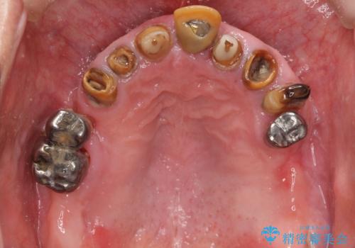 他院でインプラントできないと言われた 上顎洞底挙上術を併用したインプラント 50代男性の治療前