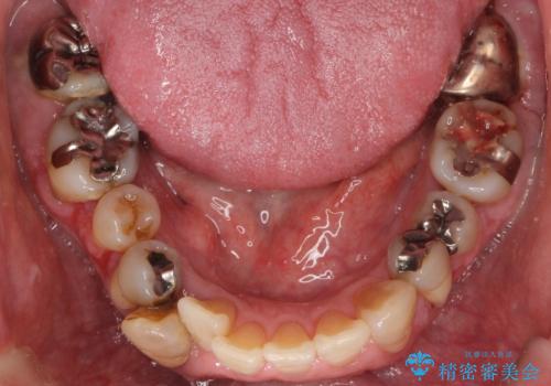 歯周病を治す 再生療法 50代男性の治療前