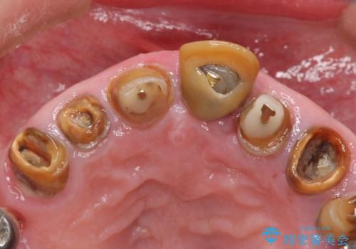 被せ物がとれたまま放置していた セラミックで綺麗に 50代男性の治療前