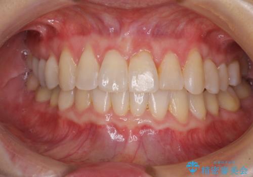 前歯のクロスバイト　インビザライン矯正で改善