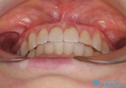 前歯のクロスバイト インビザライン矯正で改善の治療後