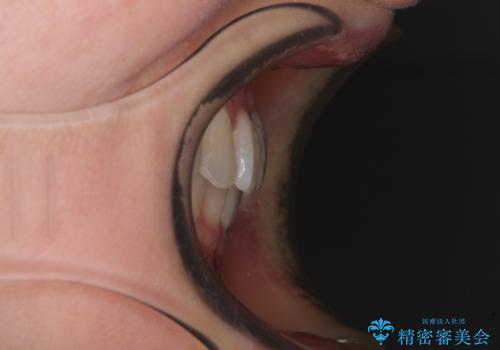 前歯のクロスバイト インビザライン矯正で改善の治療後