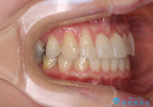前歯のクロスバイト インビザライン矯正で改善の治療後