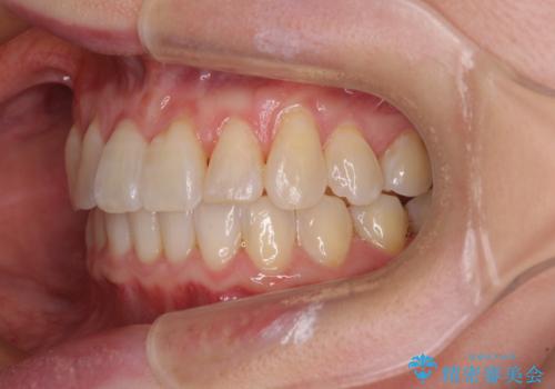 前歯のクロスバイト インビザライン矯正で改善の治療後