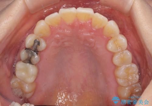 前歯のクロスバイト インビザライン矯正で改善の治療後