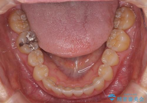 前歯のクロスバイト インビザライン矯正で改善の治療後