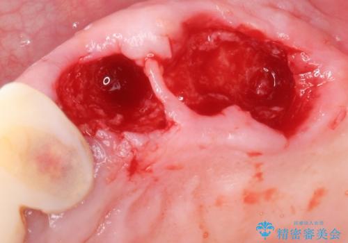 他院でインプラントできないと言われた 上顎洞底挙上術を併用したインプラント 50代男性の治療中
