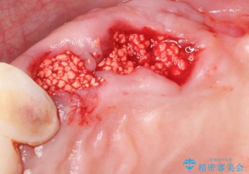 他院でインプラントできないと言われた 上顎洞底挙上術を併用したインプラント 50代男性の治療中