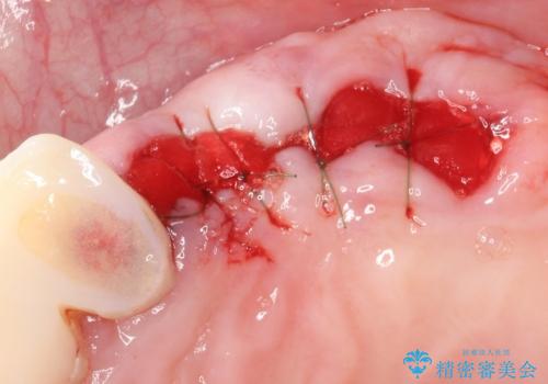 他院でインプラントできないと言われた 上顎洞底挙上術を併用したインプラント 50代男性の治療中