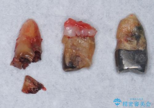 他院でインプラントできないと言われた 上顎洞底挙上術を併用したインプラント 50代男性の治療前