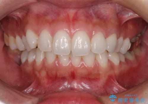 保険診療の変色したクラウン 前歯の審美歯科治療の治療後