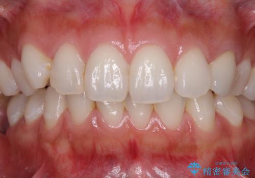 保険診療の変色したクラウン　前歯の審美歯科治療の治療後