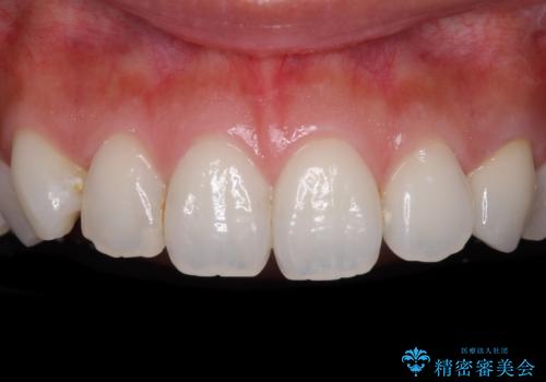 保険診療の変色したクラウン 前歯の審美歯科治療の症例 治療後