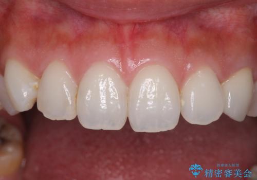 保険診療の変色したクラウン 前歯の審美歯科治療の治療後