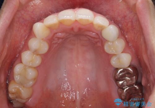 保険診療の変色したクラウン　前歯の審美歯科治療の治療後