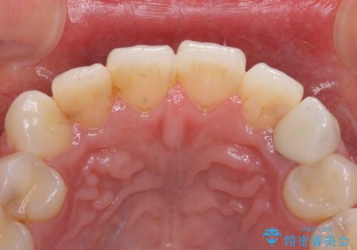 保険診療の変色したクラウン 前歯の審美歯科治療の治療後