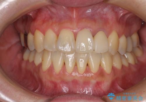 反対咬合で痛む前歯を改善　インビザラインによる矯正治療