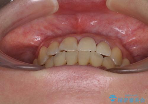 反対咬合で痛む前歯を改善　インビザラインによる矯正治療の治療後
