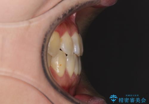 反対咬合で痛む前歯を改善 インビザラインによる矯正治療の治療後