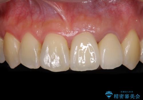 反対咬合で痛む前歯を改善 インビザラインによる矯正治療の治療後