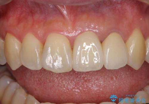 反対咬合で痛む前歯を改善　インビザラインによる矯正治療の治療後