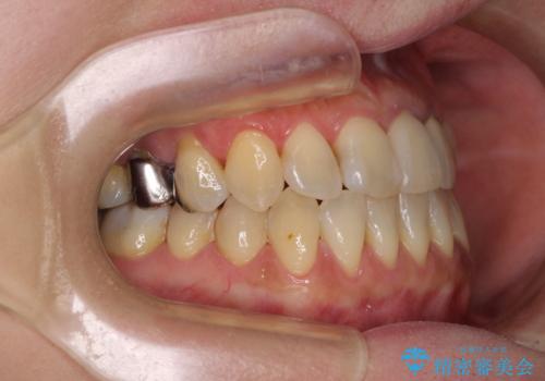 反対咬合で痛む前歯を改善 インビザラインによる矯正治療の治療後