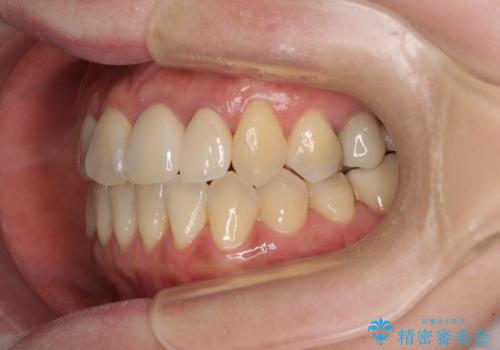 反対咬合で痛む前歯を改善 インビザラインによる矯正治療の治療後