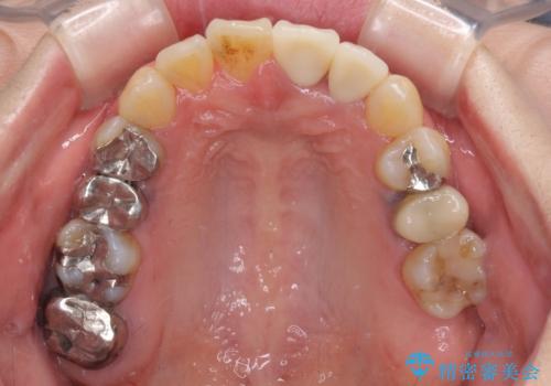 反対咬合で痛む前歯を改善 インビザラインによる矯正治療の治療後