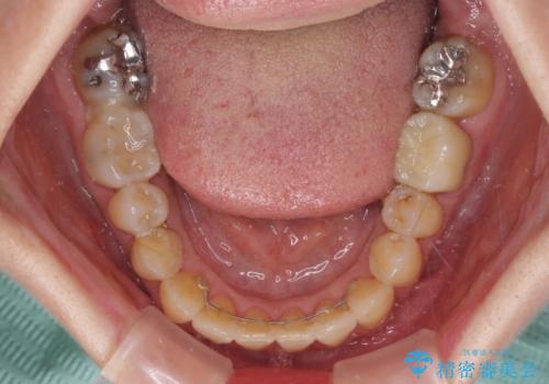 反対咬合で痛む前歯を改善 インビザラインによる矯正治療の治療後