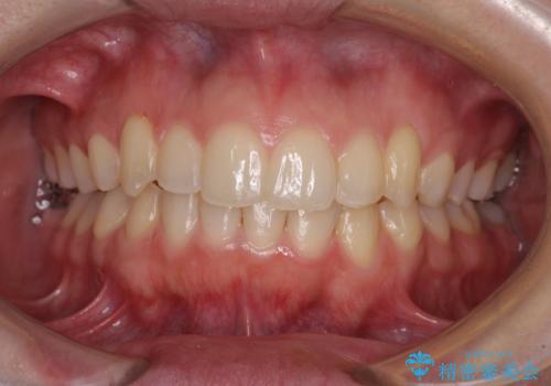骨格的に左右にずれいている　前歯のデコボコをインビザラインで解消の症例 治療後