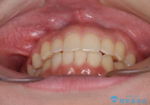 骨格的に左右にずれいている 前歯のデコボコをインビザラインで解消の治療後