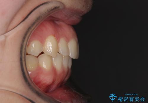 骨格的に左右にずれいている 前歯のデコボコをインビザラインで解消の治療後