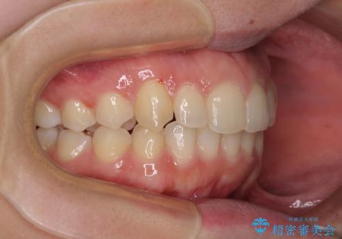 骨格的に左右にずれいている　前歯のデコボコをインビザラインで解消の治療後