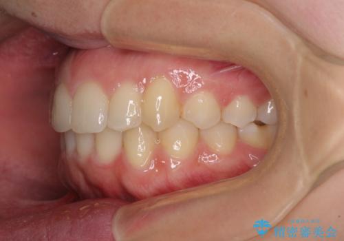 骨格的に左右にずれいている 前歯のデコボコをインビザラインで解消の治療後