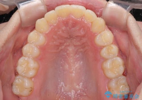 骨格的に左右にずれいている 前歯のデコボコをインビザラインで解消の治療後