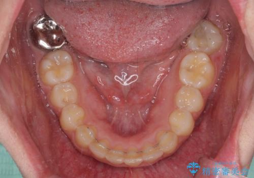 骨格的に左右にずれいている 前歯のデコボコをインビザラインで解消の治療後